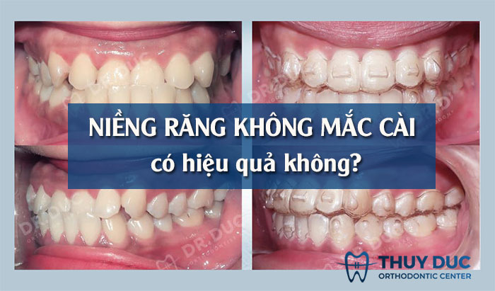 3 SỰ THẬT THÚ VỊ VỀ NIỀNG RĂNG