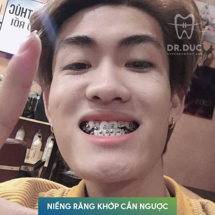 Niềng răng 1 Niềng răng 1