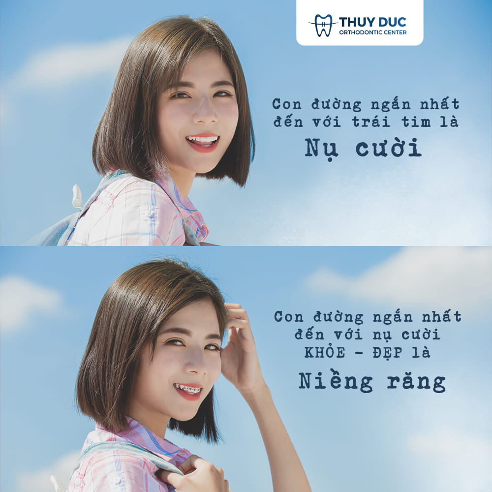 Niềng răng khớp cắn sâu và những lưu ý quan trọng 1 Niềng răng khớp cắn sâu và những lưu ý quan trọng 1