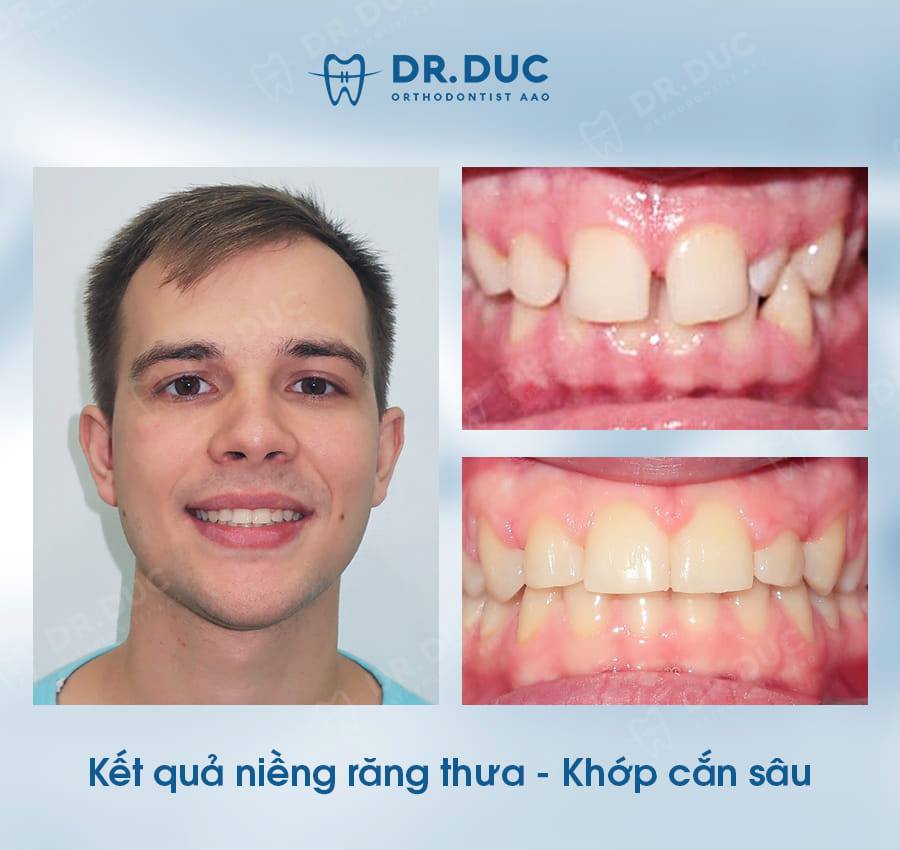 Quy trình niềng răng khớp cắn sâu 1 Quy trình niềng răng khớp cắn sâu 1