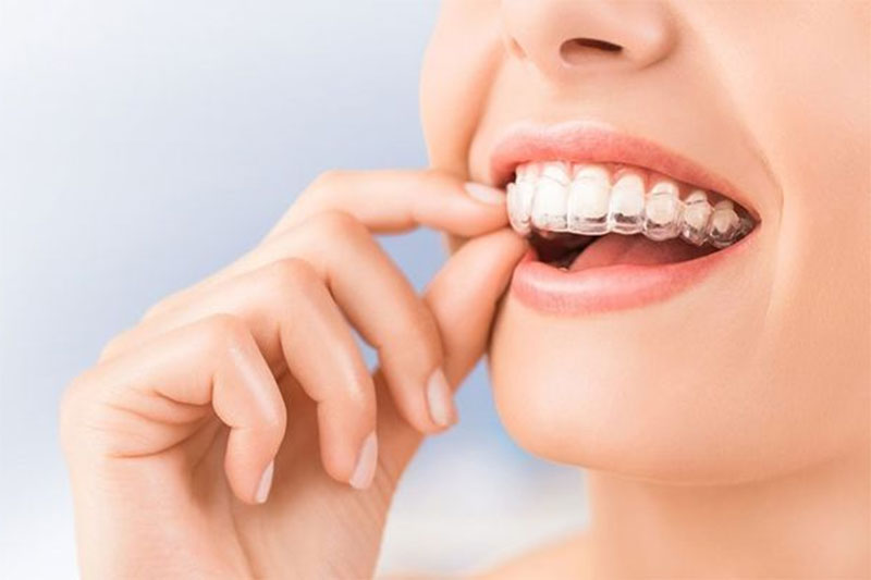 Niềng răng trong suốt Invisalign 1