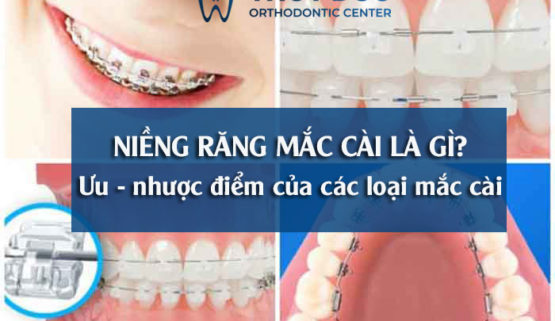Niềng răng mắc cài là gì? Các loại niềng răng mắc cài