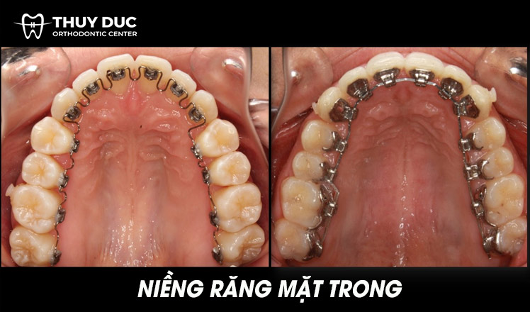 Niềng răng mắc cài mặt trong 1 Niềng răng mắc cài mặt trong 1