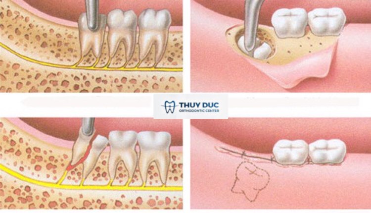 Quy trình nhổ răng khôn khi niềng răng 1