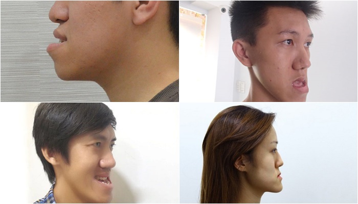 Răng quặp làm mất cân đối khuôn mặt 1 Răng quặp làm mất cân đối khuôn mặt 1
