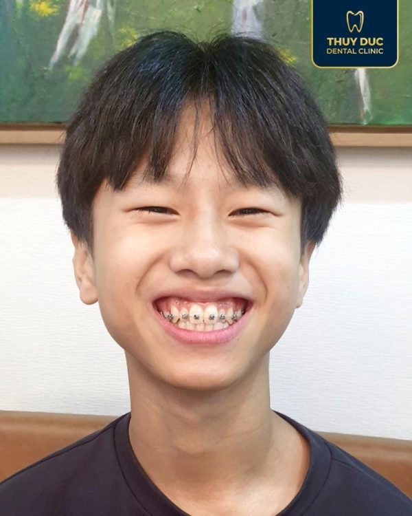 Trẻ phải đeo niềng răng trong bao lâu mới có hiệu quả? 1 Trẻ phải đeo niềng răng trong bao lâu mới có hiệu quả? 1