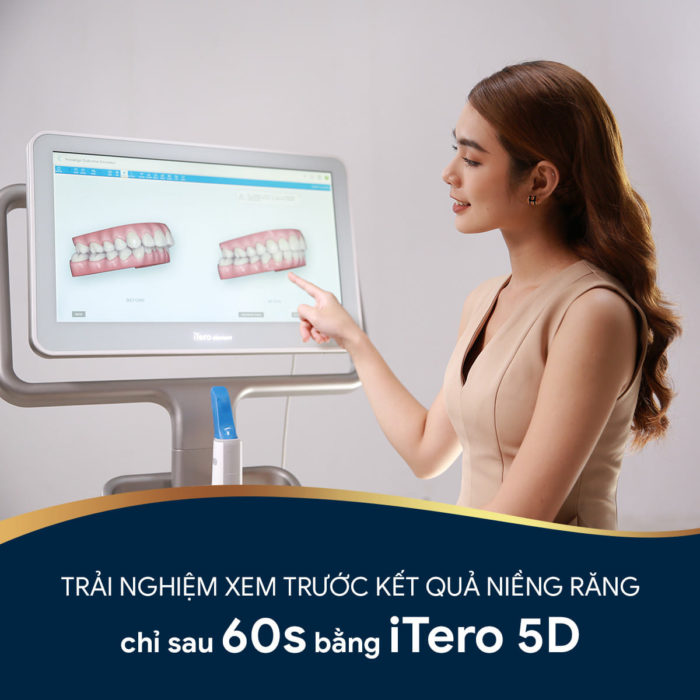 Quy trình làm khay niềng trong suốt Invisalign 1 Quy trình làm khay niềng trong suốt Invisalign 1