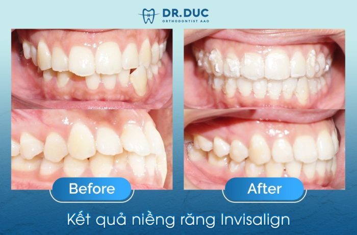 5 điều quan trọng cần biết trước khi niềng răng trong suốt Invisalign 1 5 điều quan trọng cần biết trước khi niềng răng trong suốt Invisalign 1