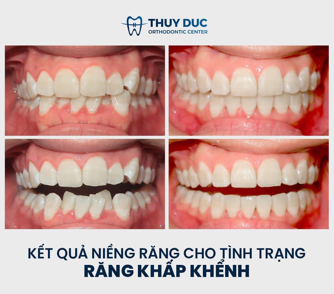 Hình ảnh trước và sau niềng răng  NHA KHOA MINH KHAI