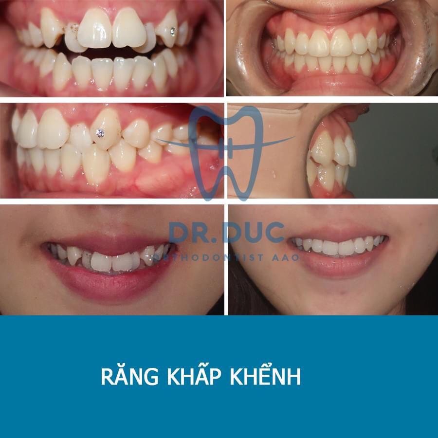 Hình ảnh thay đổi ngoạn mục trước và sau khi niềng răng