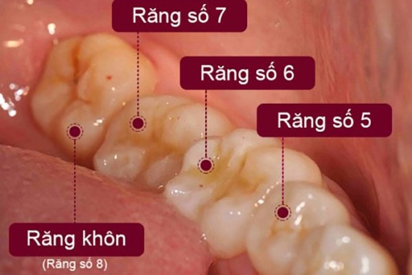 Răng số 5 là răng nào? 1 Răng số 5 là răng nào? 1