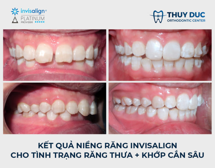 Đối với trường hợp khớp cắn sâu do răng 2 Đối với trường hợp khớp cắn sâu do răng 2