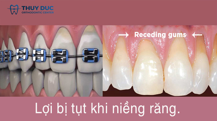 Bị tụt lợi khi niềng răng 1