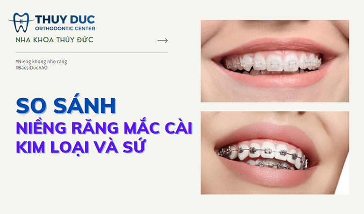 Niềng răng mắc cài loại nào tốt? Nên niềng răng bằng mắc cài sứ hay kim loại? 1