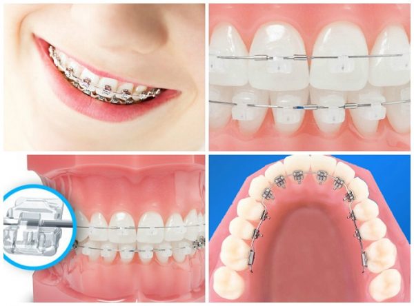 Nên niềng răng mặt trong hay niềng răng mặt ngoài 1 So sánh niềng răng mặt trong và mặt ngoài