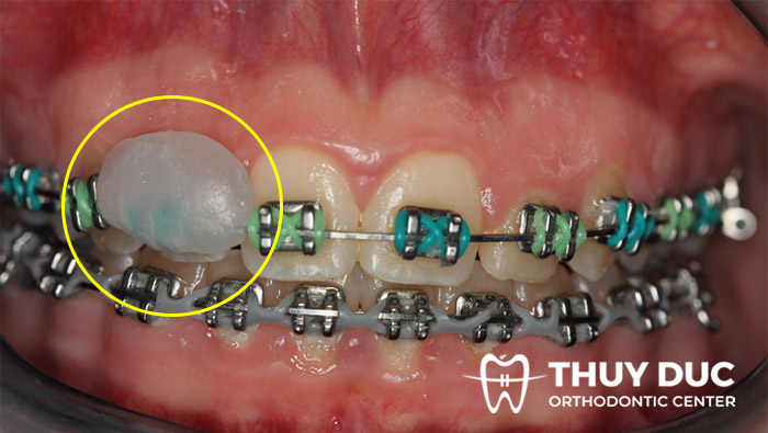 3/ Thoa sáp nha khoa trước khi hôn 1