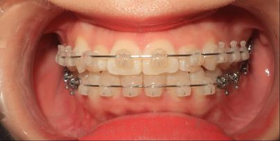 Hình ảnh niềng răng với mắc cài sứ 2