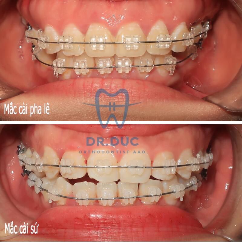 Hình ảnh niềng răng với mắc cài sứ 1