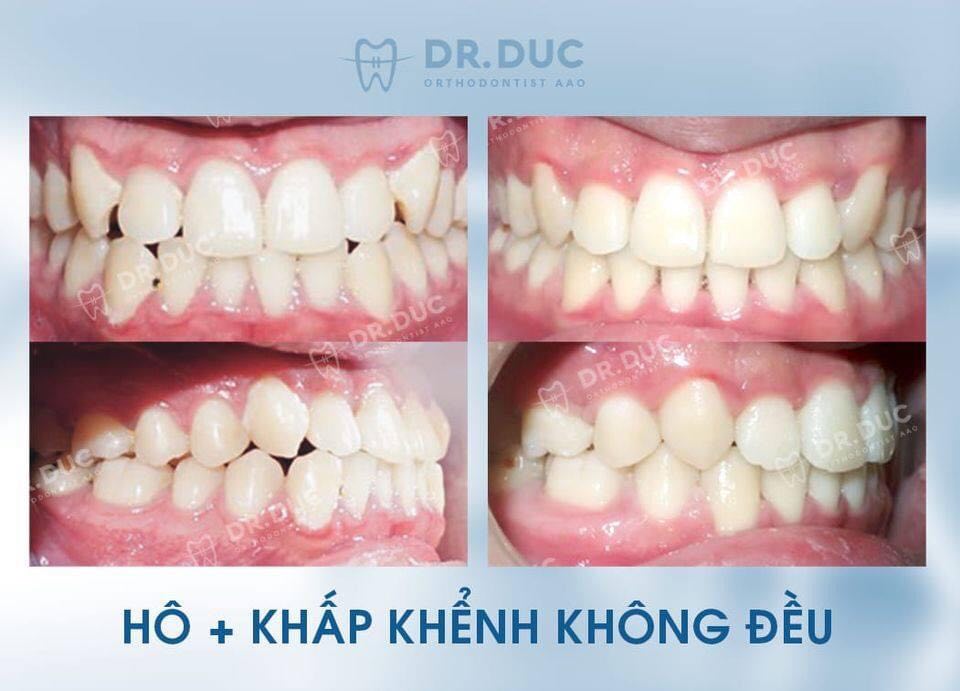 Hình ảnh trước - sau khi niềng răng hô, vẩu 1