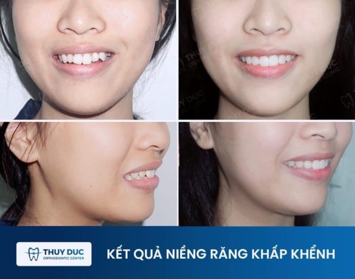 Hình ảnh Thay đổi Ngoạn Mục Trước Và Sau Khi Niềng Răng 6619