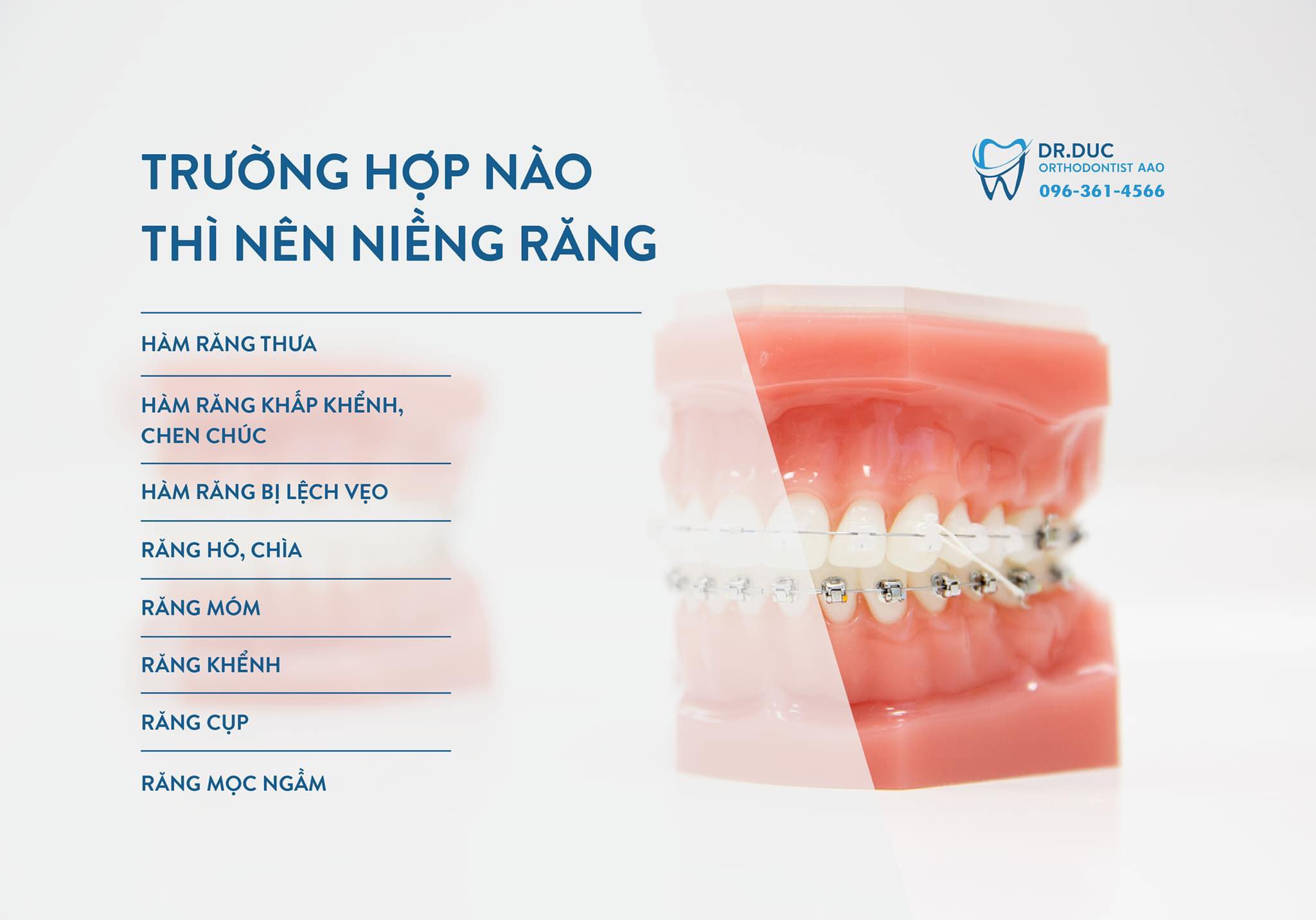 Khi nào trẻ nên niềng răng? 1 Khi nào trẻ nên niềng răng? 1