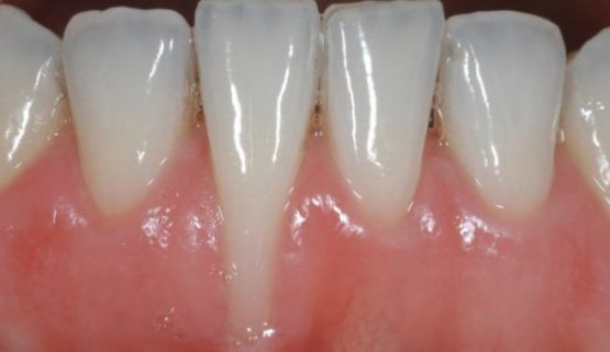 Tụt lợi là gì? Dấu hiệu nhận biết 2 Tụt lợi là gì? Dấu hiệu nhận biết 2