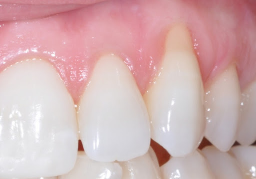 Tụt lợi là gì? Dấu hiệu nhận biết 1 Tụt lợi là gì? Dấu hiệu nhận biết 1