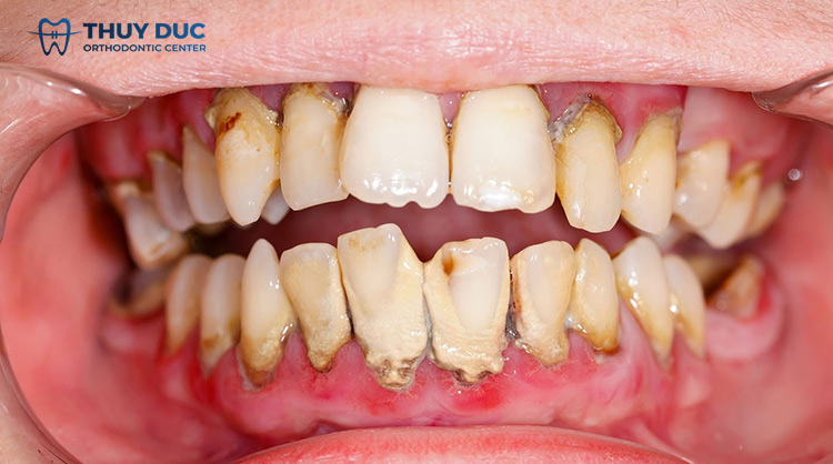 Sức khỏe răng miệng ảnh hưởng đến sức khỏe tổng thể của bạn như thế nào? 1 Sức khỏe răng miệng ảnh hưởng đến sức khỏe tổng thể của bạn như thế nào? 1