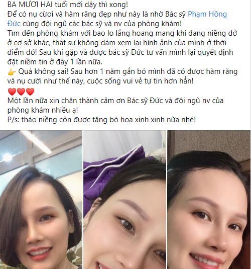 Niềng răng hô hàm dưới ở đâu tốt nhất? 2 Niềng răng hô hàm dưới ở đâu tốt nhất? 2