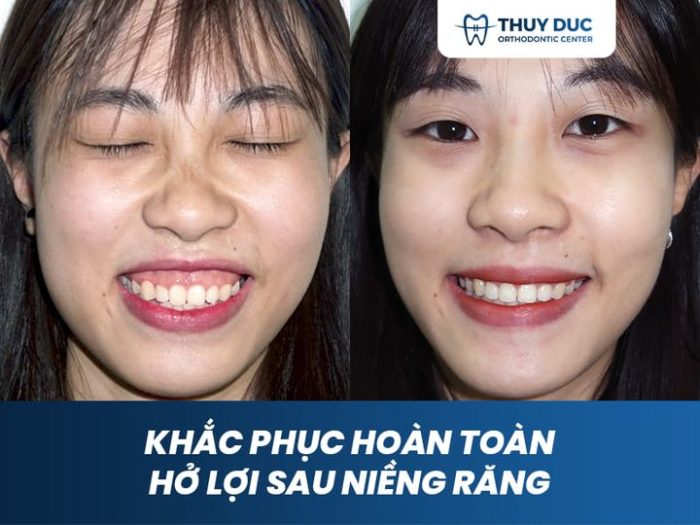 Niềng răng chữa cười hở lợi có hiệu quả không? 1 Niềng răng chữa cười hở lợi có hiệu quả không? 1