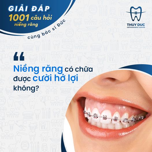 Niềng răng chữa cười hở lợi có hiệu quả không? 1 Niềng răng chữa cười hở lợi có hiệu quả không? 1