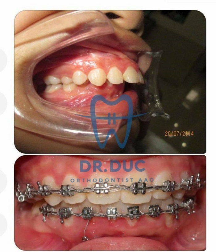 Phương pháp niềng răng hô 1 Phương pháp niềng răng hô 1