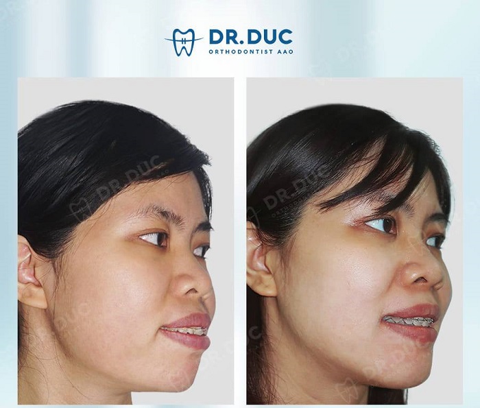 Chỉnh răng hô bằng phương pháp niềng răng 1