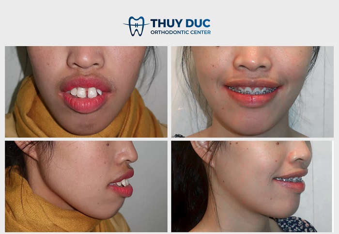 Hình ảnh chỉnh răng hô bằng niềng răng 3 Hình ảnh chỉnh răng hô bằng niềng răng 3