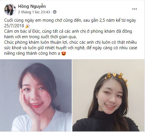Niềng răng hô hàm dưới ở đâu tốt nhất? 3 Niềng răng hô hàm dưới ở đâu tốt nhất? 3