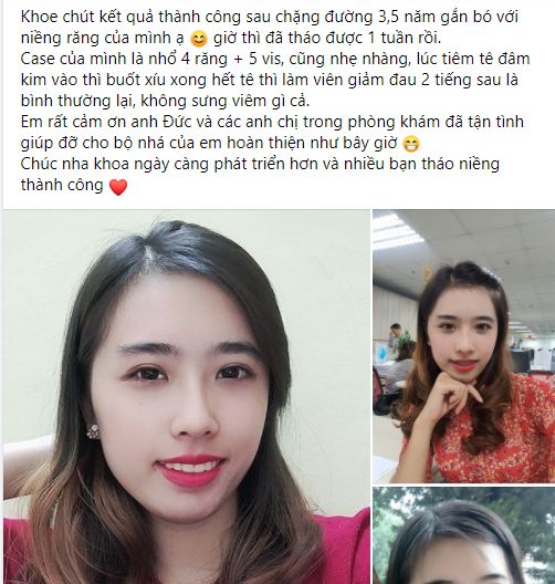 Niềng răng hô hàm dưới ở đâu tốt nhất? 4 Niềng răng hô hàm dưới ở đâu tốt nhất? 4