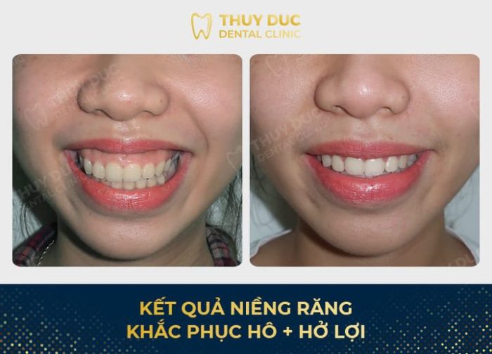 Lựa chọn địa chỉ niềng răng chữa cười hở lợi uy tín tại Hà Nội 1 Lựa chọn địa chỉ niềng răng chữa cười hở lợi uy tín tại Hà Nội 1