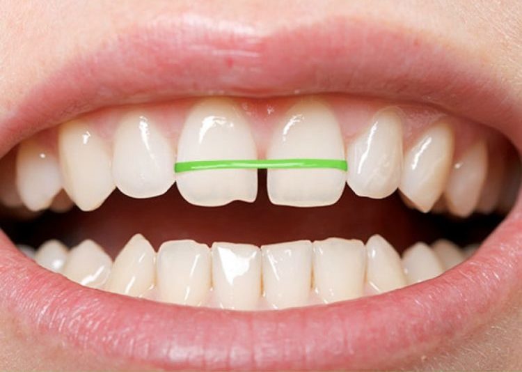 Tìm hiểu về dây thun trong bộ khí cụ niềng răng 1