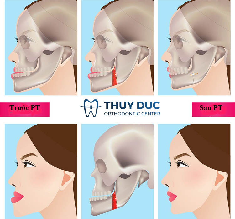 Phẫu thuật hàm 2 Phẫu thuật hàm 2