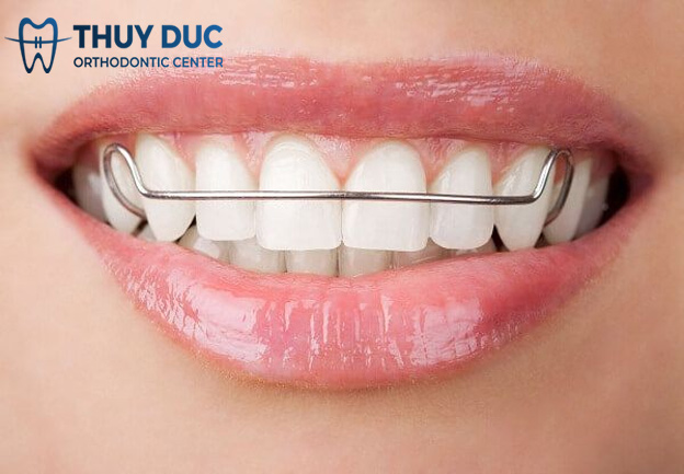 Thời gian đeo hàm duy trì Hawley phụ thuộc vào yếu tố nào? 1