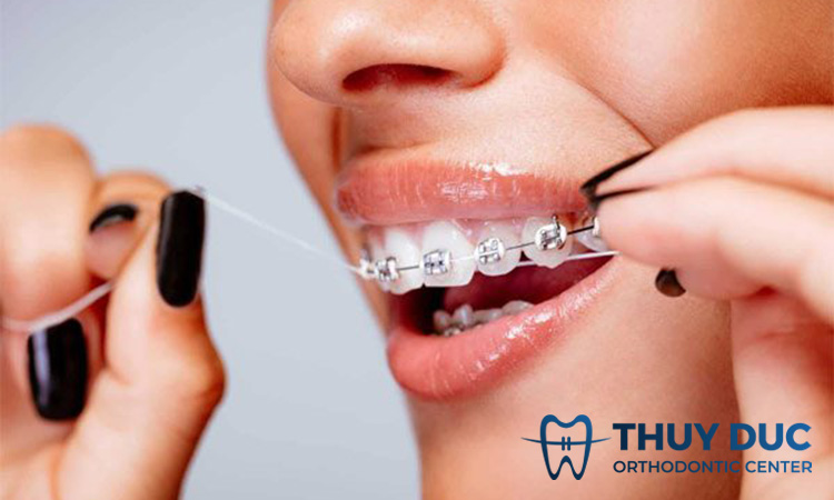 Hướng dẫn cách dùng chỉ nha khoa cho người niềng răng 1