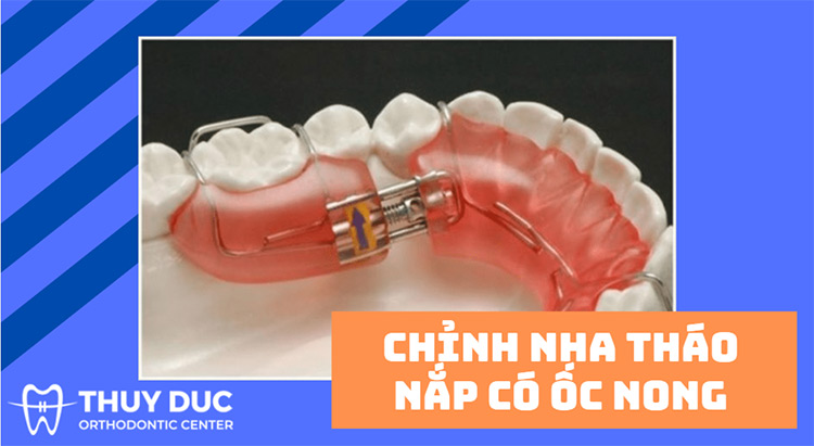 Tìm hiểu ưu - nhược điểm của chỉnh nha tháo lắp có ốc nong 1 Tìm hiểu ưu - nhược điểm của chỉnh nha tháo lắp có ốc nong 1