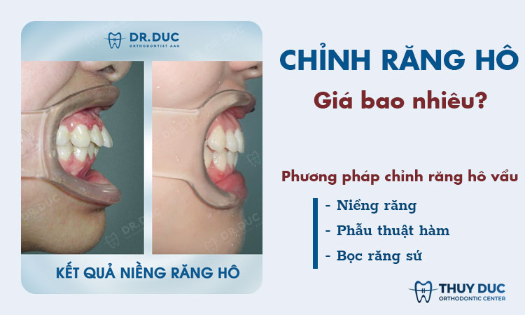 Chỉnh răng hô vẩu giá bao nhiêu? 1