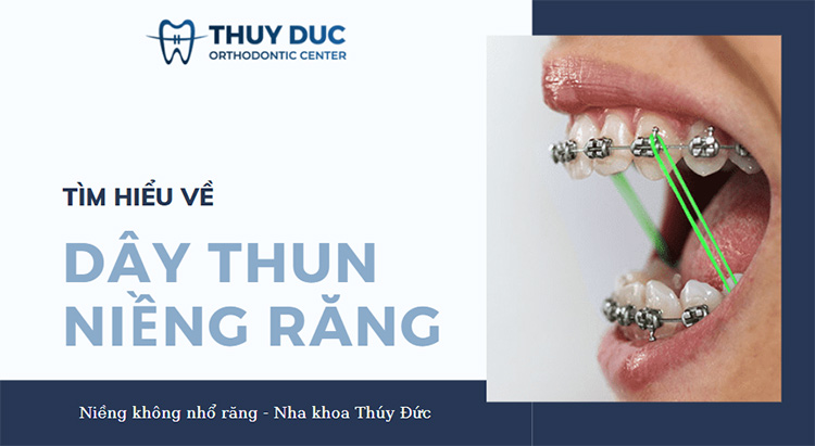 Có những rủi ro nào liên quan đến việc đeo dây thun khi niềng răng?