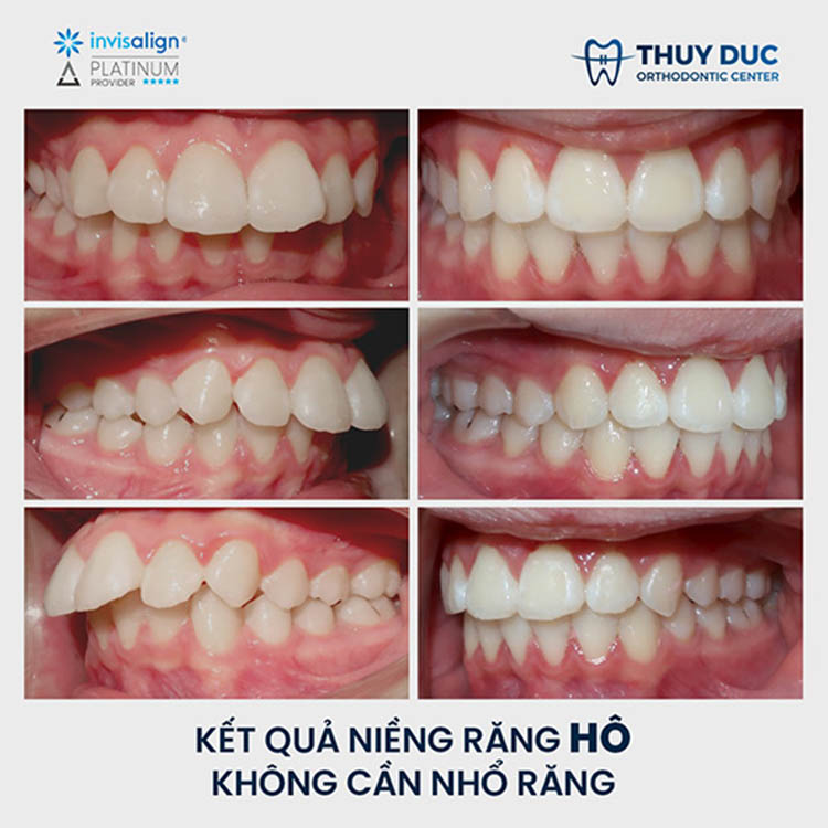 Tại sao bạn nên niềng răng hô tại nha khoa Thúy Đức? 3 Tại sao bạn nên niềng răng hô tại nha khoa Thúy Đức? 3