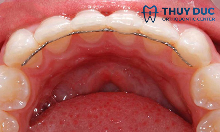 Hàm duy trì cố định 1 Hàm duy trì cố định 1