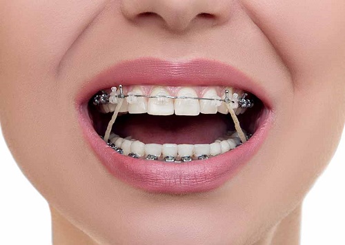 Giai đoạn sau 9 tháng niềng răng 1 Giai đoạn sau 9 tháng niềng răng 1