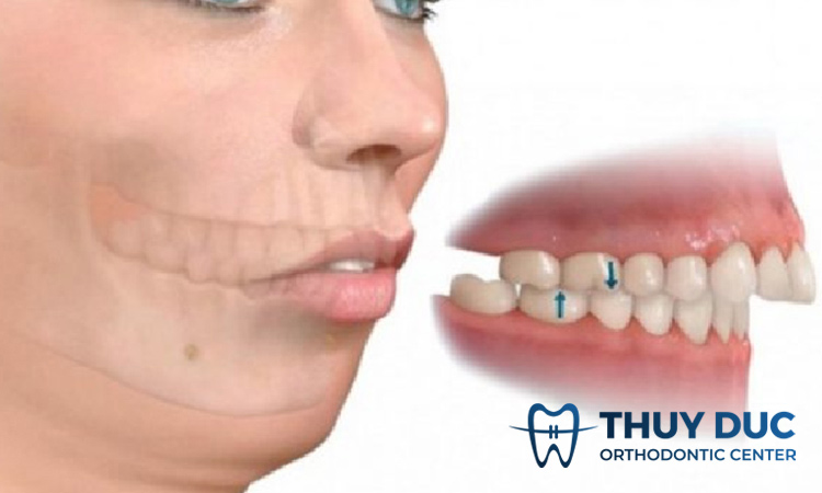 Niềng răng có cải thiện được hàm lệch không? 1