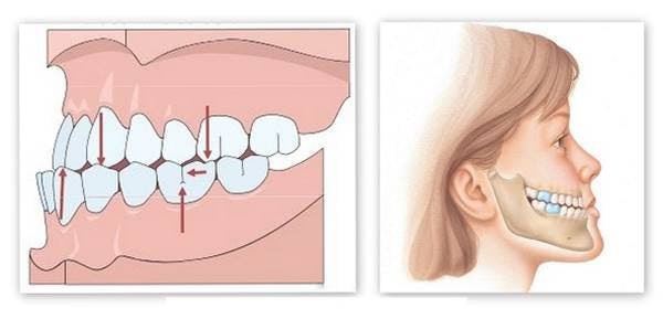 Tác hại của răng móm đối với trẻ em 1 Tác hại của răng móm đối với trẻ em 1