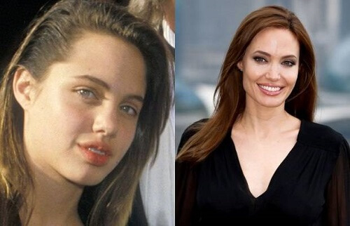 Niềng răng xong đẹp như thế nào? Các ca niềng răng hô của sao 2